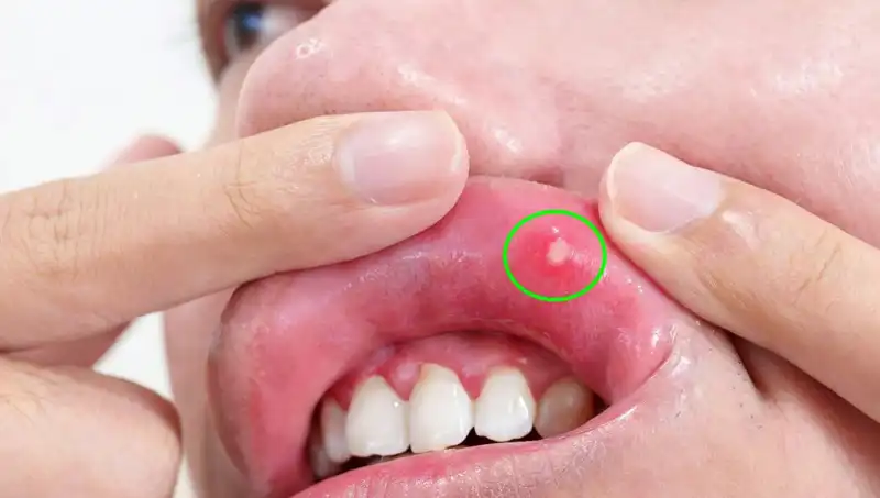 Kanserin Korkutucu Uyarısı: Dili Alınmak Zorunda Kaldı