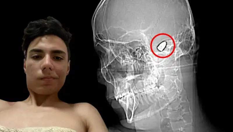 Kafasının İçinde Patlama Riskini Taşıyan Genç Benzersiz Bir Mücadele Veriyor